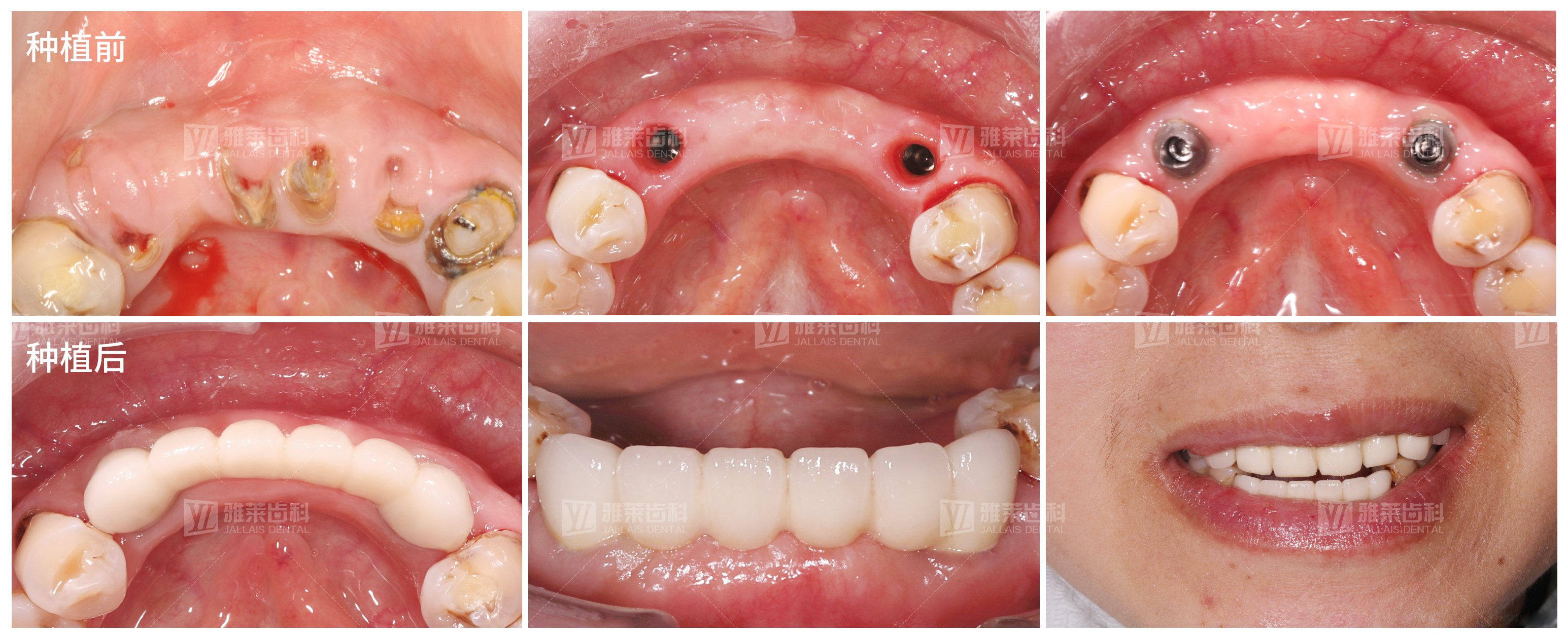 种植牙是牙缺失的优选修复方式,在缺牙区牙床内以外科手术的方式植入